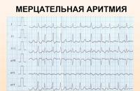 Ограничения и противопоказания для жизни после установки кардиостимулятора Показания к постановке кардиостимулятора