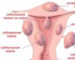 Treatment options for uterine fibroids without surgery The most fictitious treatment for active fibroids of the mind