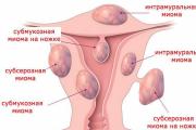 Treatment options for uterine fibroids without surgery The most fictitious treatment for active fibroids of the mind