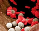 Повишени бели кръвни клетки в цитонамазка при жени: причини