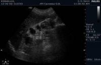 Döş xərçənginin ultrasəs diaqnozu