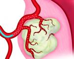 Opções de tratamento para miomas uterinos sem cirurgia O tratamento mais fictício para miomas ativos da mente